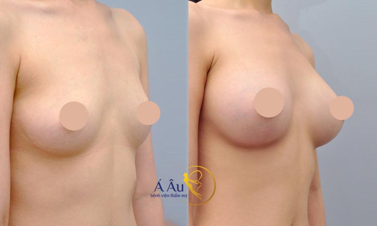 Hình ảnh nâng ngực nội soi tại Bệnh viện thẩm mỹ Á ÂU.
