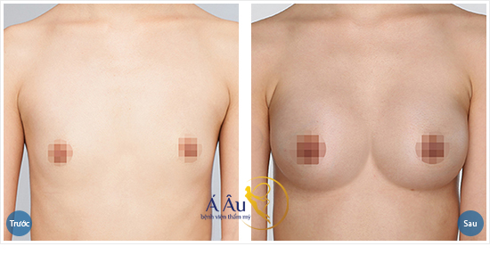 Hình ảnh trước và sau khi nâng ngực tại Á Âu