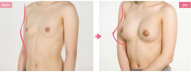 Hình ảnh trước và sau nâng ngực tại Bệnh viện thẩm mỹ Á Âu.