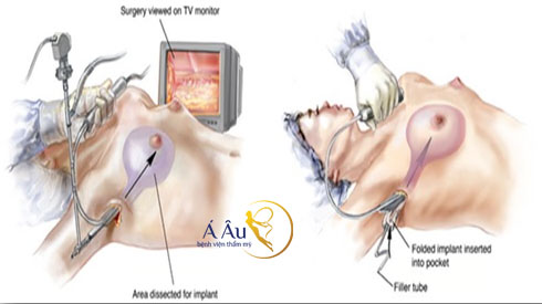 Công nghệ nâng ngực nội soi được ứng dụng tại Á Âu.