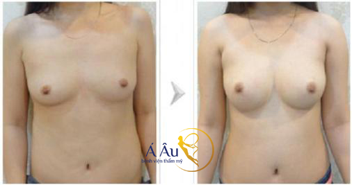 Hình ảnh trước và sau nâng ngực tại Bệnh viện thẩm mỹ Á ÂU.