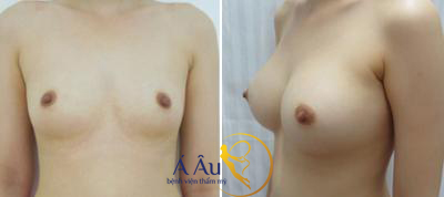 Hình ảnh trước và sau khi nâng ngực tại Bệnh viện thẩm mỹ Á Âu.