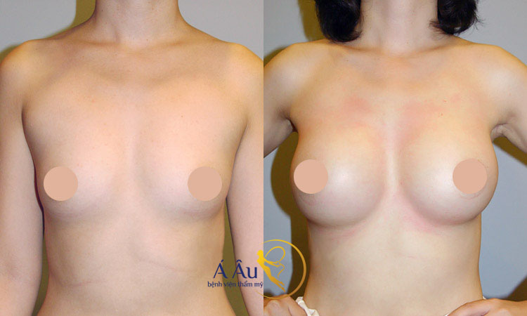 Hình ảnh trước và sau khi nâng ngực nội soi tại Á Âu.
