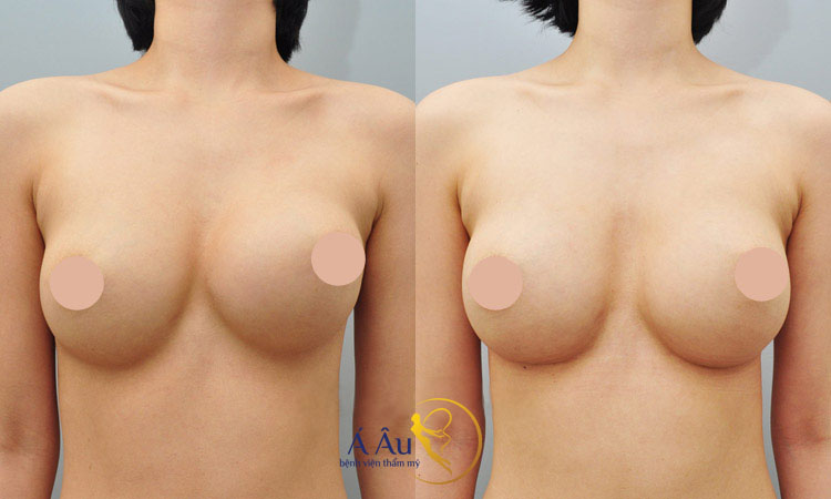 Hình ảnh trước sau nâng ngực tại Bệnh viện thẩm mỹ Á Âu.