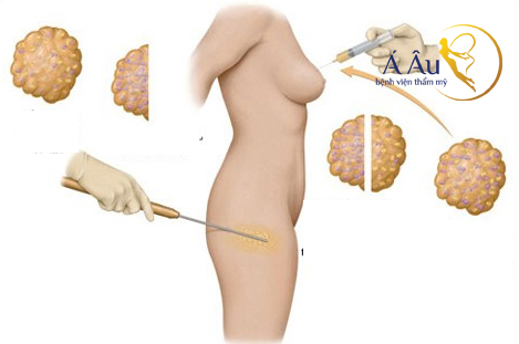 Kỹ thuật lấy mỡ trong nâng ngực mỡ tự thân.