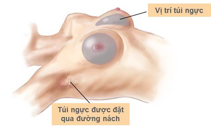 Công nghệ nâng ngực nội soi tại Bệnh viện thẩm mỹ Á Âu.
