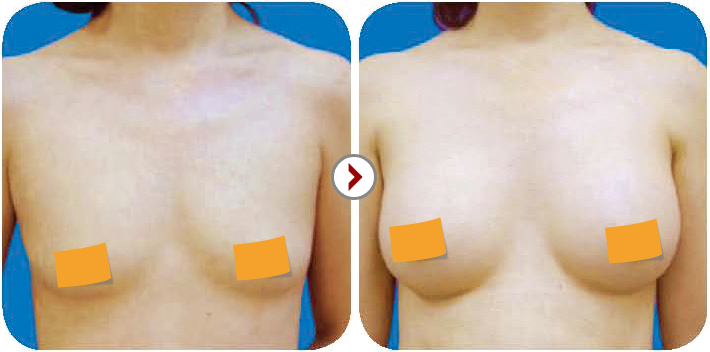 Nâng ngực nội soi 3D