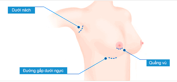 phương pháp nâng ngực nội soi