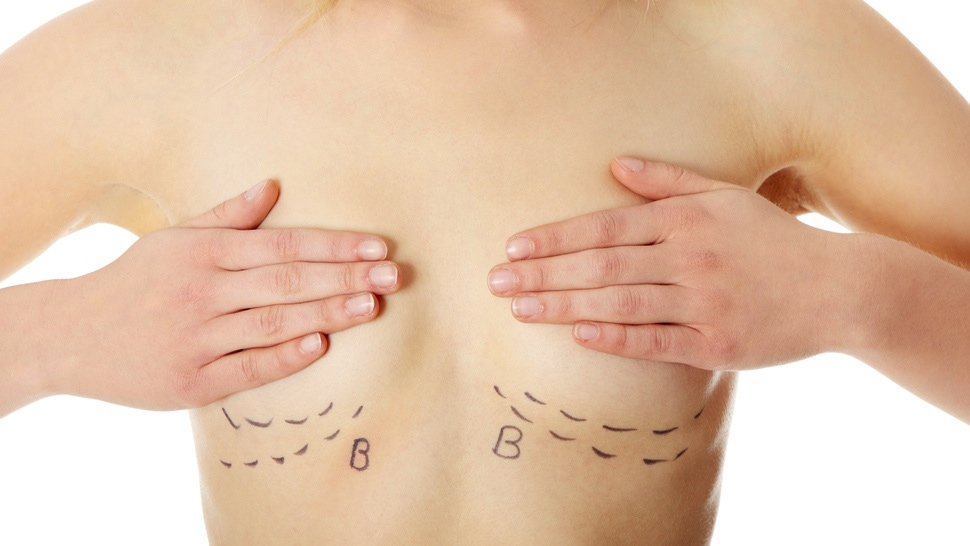 ưu và nhược điểm nâng ngực nội soi